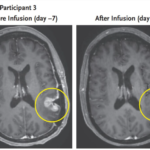 Imagens mostram tumor antes e após o tratamento