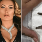 Andressa Urach mostrou costelas retiradas após cirurgia