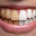 Clareamento dental: saiba o que funciona e o que deve ser evitado