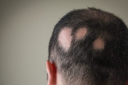 Médicos lançam novo consenso para tratar alopecia areata, que causa queda de cabelo; veja o que muda