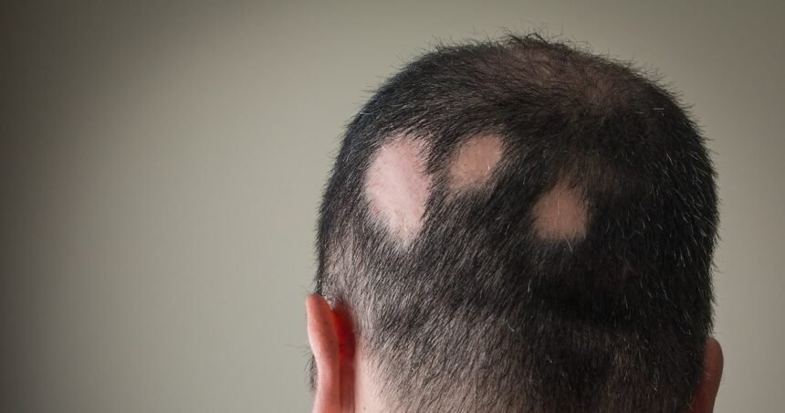 Médicos lançam novo consenso para tratar alopecia areata, que causa queda de cabelo; veja o que muda